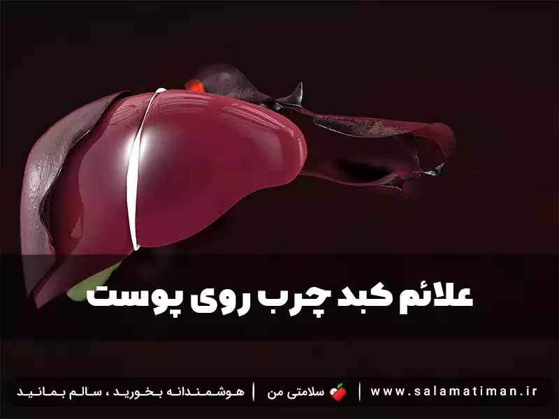 علائم کبد چرب روی پوست